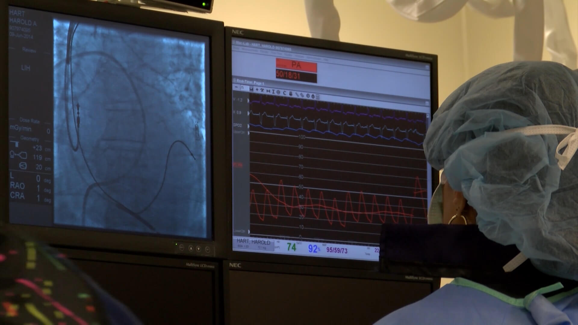 The CardioMEMS wireless heart monitor