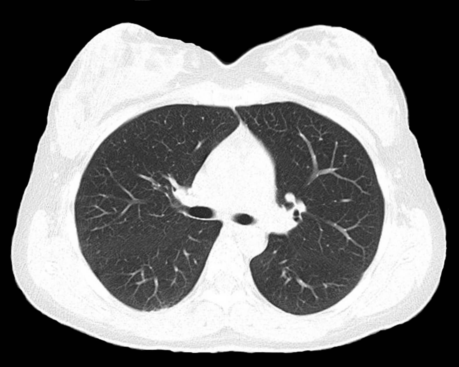 Normal lungs on computed tomography scan